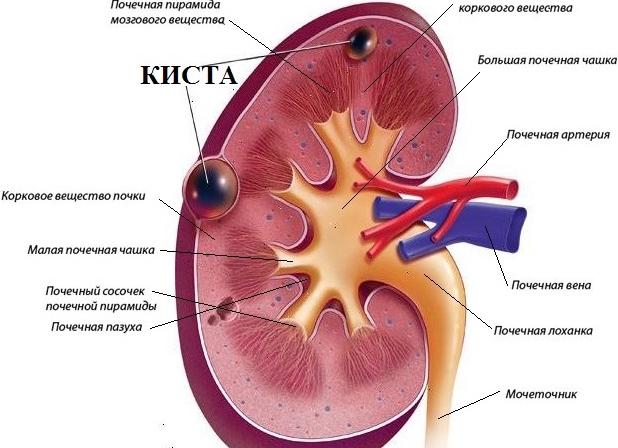 Как лечится поликистоз почек
