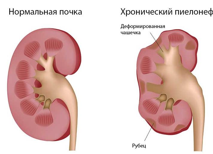 Проявления хронического пиелонефрита и особенности его лечения