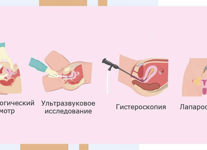 Симптомы разрыва кисты яичника
