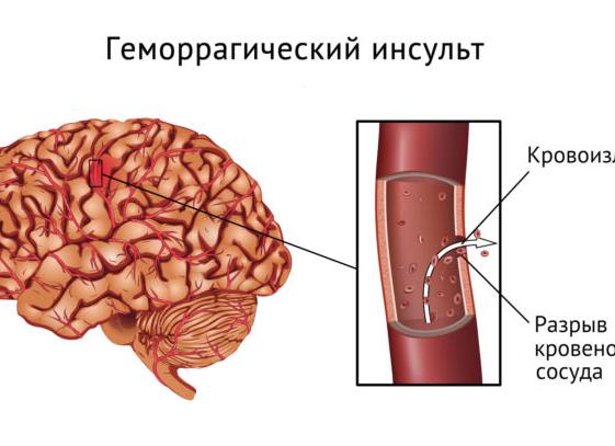 ТОП 13 препаратов-заменителей Ксарелто: список более дешевых аналогов