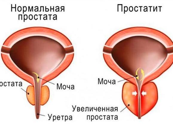 15 причин учащенного мочеиспускания у мужчин, женщин и детей