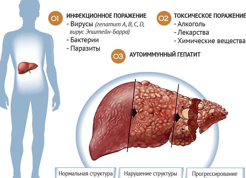 Где и как болит печень — причины и возможные симптомы, диагностика