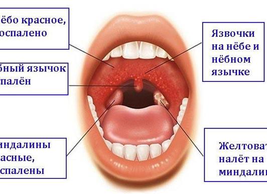 Как лечить герпесную ангину у детей и каковы ее причины?