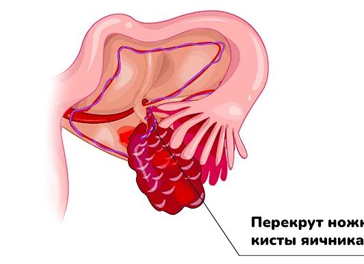 Перекрут ножки кисты яичника