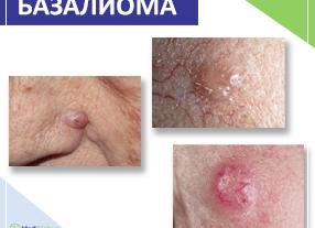 Как лечить базалиому кожи носа облучением и народными средствами