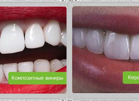 Что такое виниры для зубов: плюсы и минусы