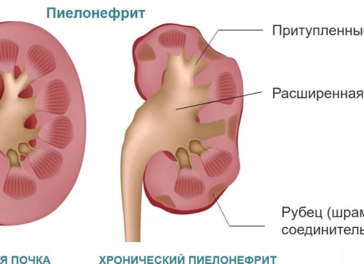 Какие симптомы и методы лечения пиелонефрита у женщин?