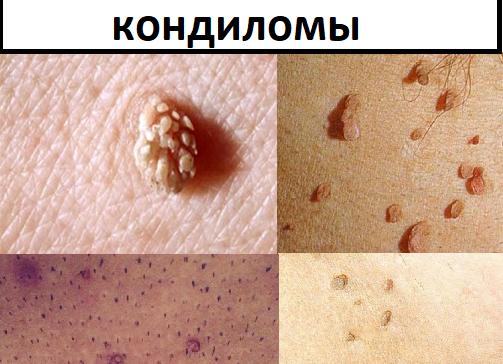 Остроконечные кондиломы