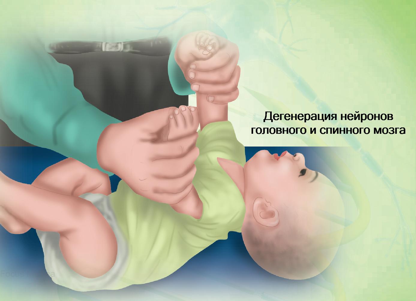Редкая и опасная болезнь Тея-Сакса — когда гены убивают