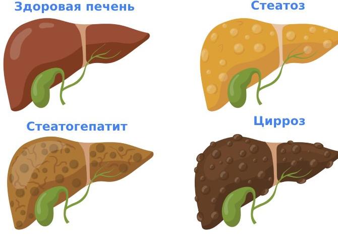 Цирроз печени – симптомы у мужчин, стадии развития