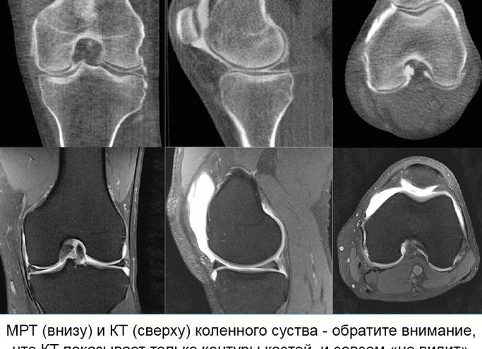 Что показывает МРТ коленного сустава и где сделать по недорогой цене?