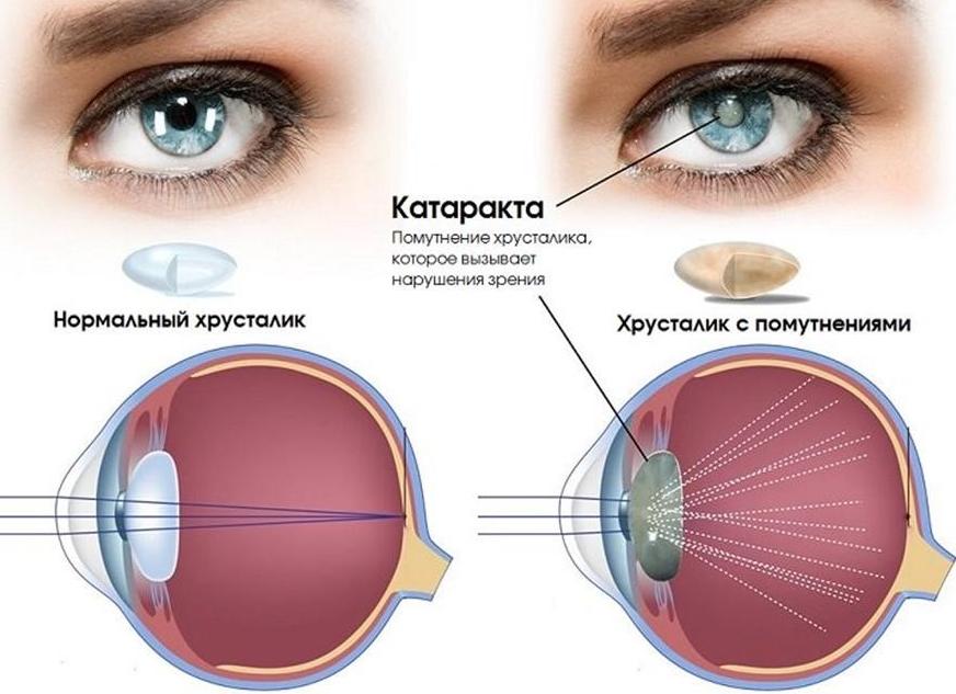 Катаракта — симптомы и первые признаки заболевания, диагностика, методы лечения и профилактические меры