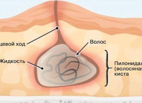 Пилонидальная киста как аномалия развития кожи в крестцово-копчиковом пространстве