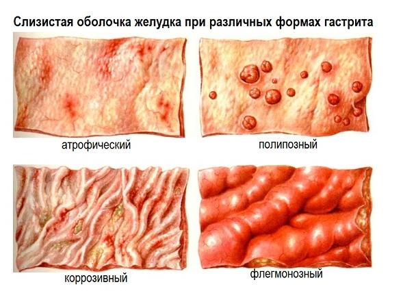 Симптомы и лечение поверхностной формы гастродуоденита