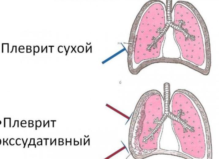 Сухой плеврит – симптомы и диагностика