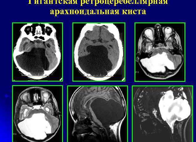 Арахноидальная киста головного мозга — непростое лечение и тяжелые последствия
