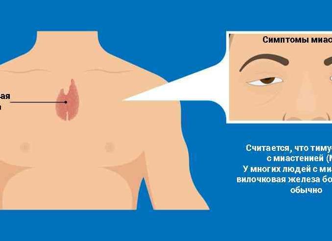 Диагноз миастения: причины, симптомы и признаки разных форм заболевания