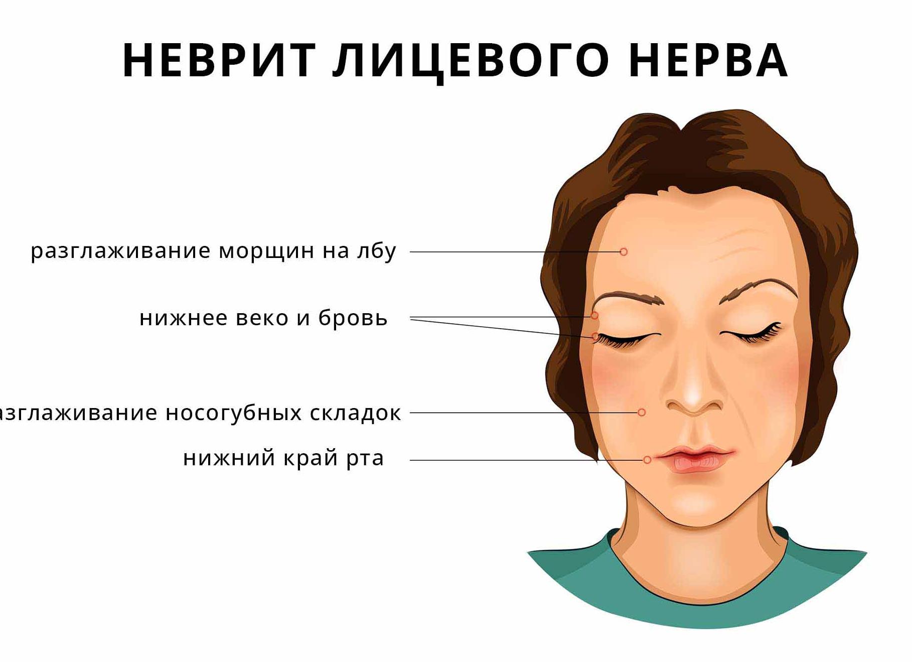 Особенности проявления и методы лечения паралича Белла