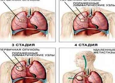 Признаки рака легких, первые симптомы и проявления