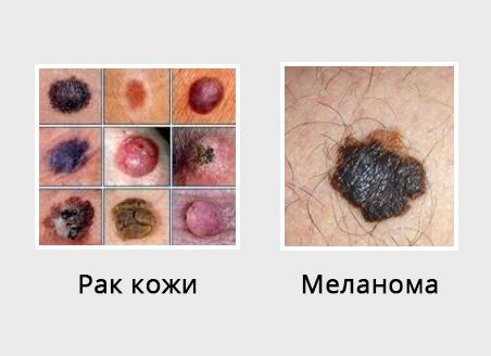 Злокачественные родинки — первые признаки перерождения