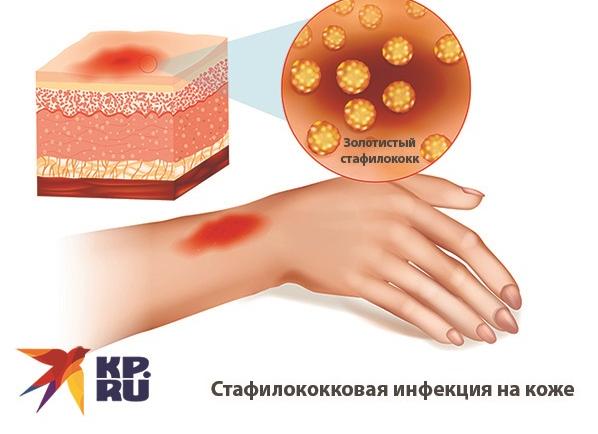 Как передается золотистый стафилококк