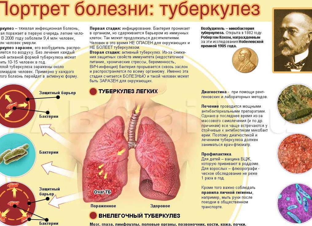 Милиарный туберкулез — особенности и причины развития, проявления, методы лечения, последствия