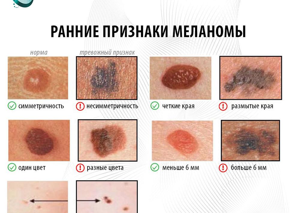 Опухоли кожи — признаки доброкачественных и злокачественных