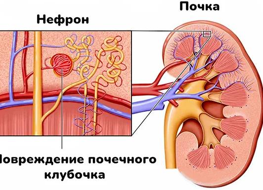 Диагностика гломерулонефрита — виды и порядок проведения исследований
