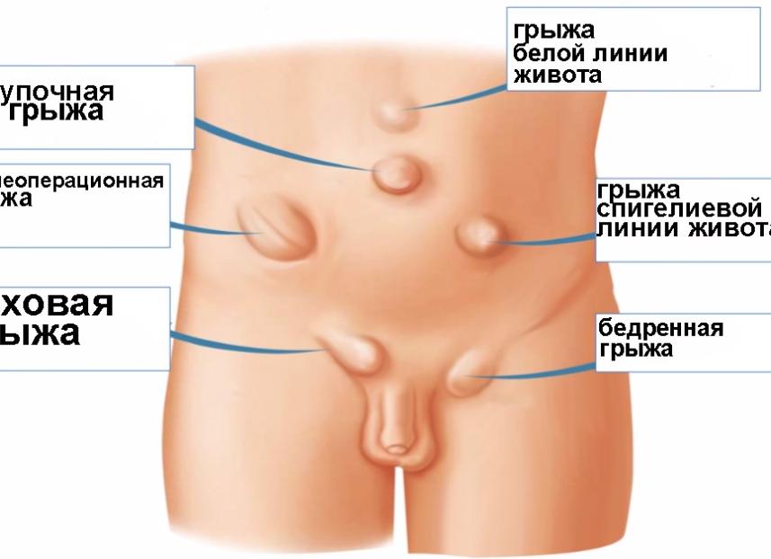 Грыжа белой линии живота