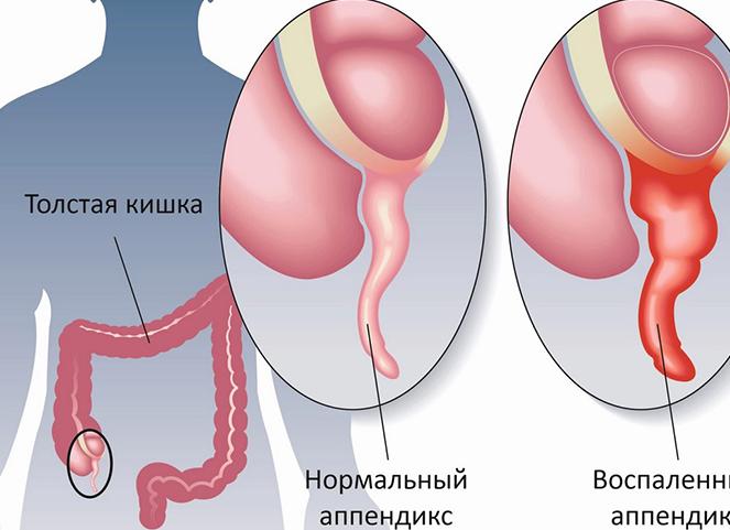 Причины аппендицита у детей и взрослых — первые симптомы