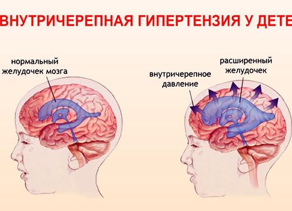Внутричерепная гипертензия у детей и взрослых