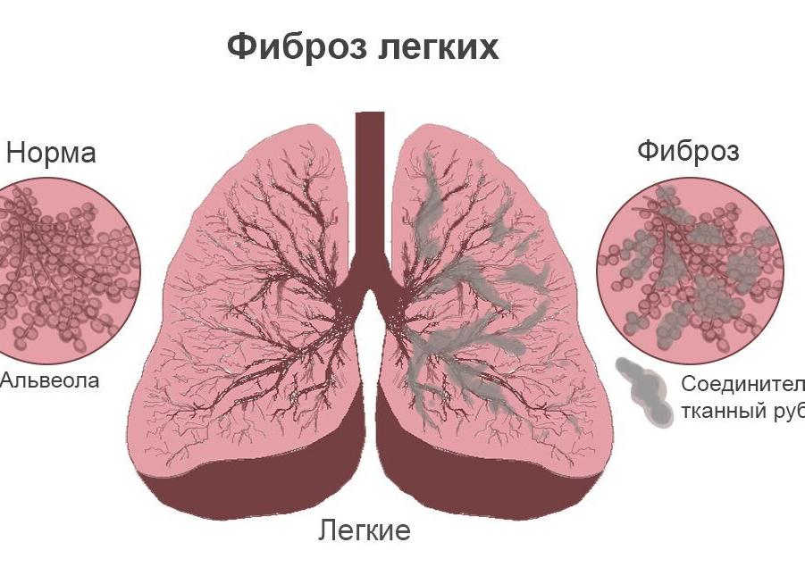 Фиброз легких