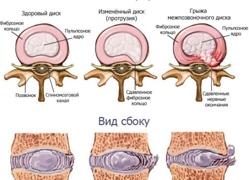 Как лечить протрузию межпозвонковых дисков шейного отдела позвоночника?