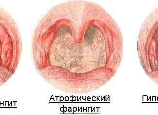 Хронический субатрофический фарингит