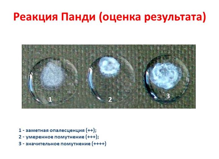 Реакция Панди: что это за исследование и для чего проводится?
