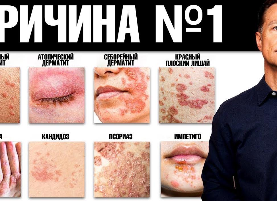 ТОП-12 аналогов Дексаметазона