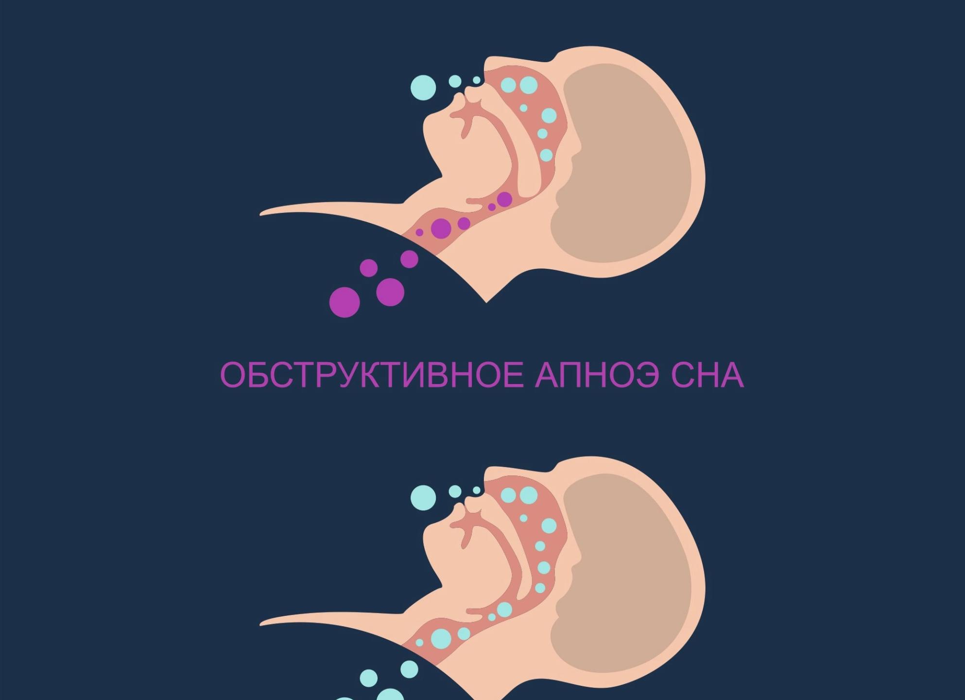 Как избавиться от храпа во сне мужчинам и женщинам? Эффективные способы и препараты