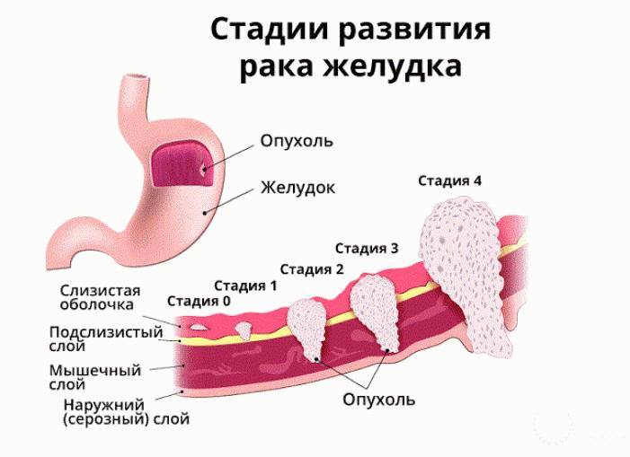 Низкодифференцированная аденокарцинома желудка: лечение и прогноз