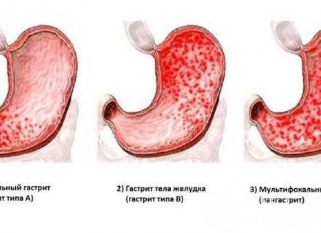 Симптомы и лечение хронического гастродуоденита