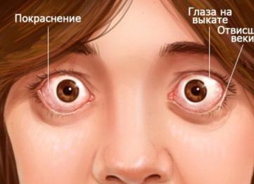 Эндокринная офтальмопатия – симптомы и классификация