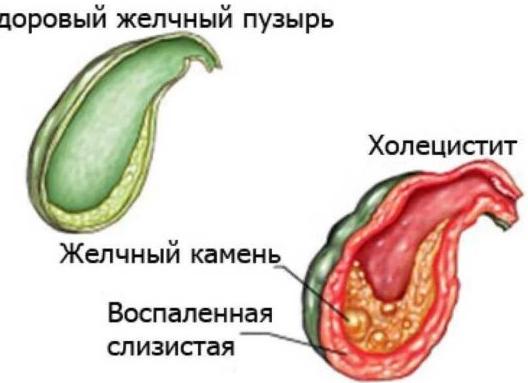 Приступ холецистита