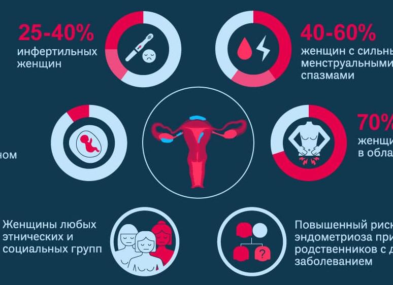 Признаки эндометриоза у женщин — характерные симптомы в зависимости от расположения очагов