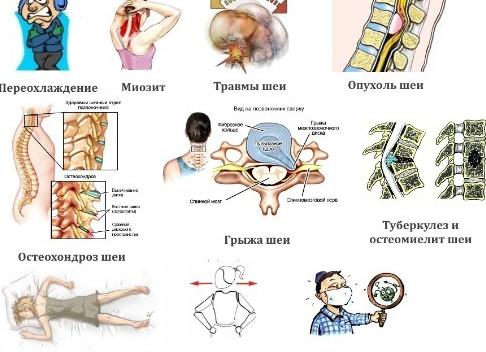 Возможные причины боли в шее и плече, отдающей в руку