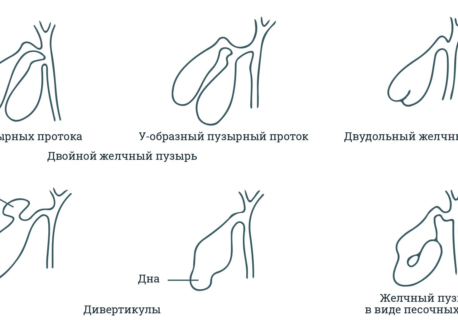 Аномальный загиб желчного пузыря — все ли мы о нем знаем?