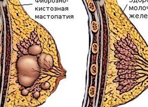 Диффузная фиброзная, кистозная и железистая мастопатия молочных желез