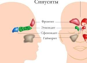 Как лечить гайморит у взрослых антибиотиками в домашних условиях?
