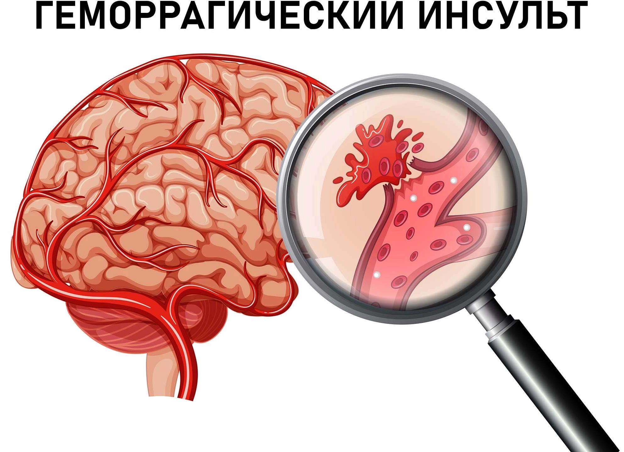 Геморрагический инсульт головного мозга — причины, симптомы, диагностика, лечение и реабилитация