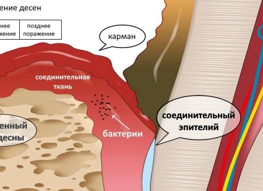 Как проводить лечение воспаления десен в домашних условиях