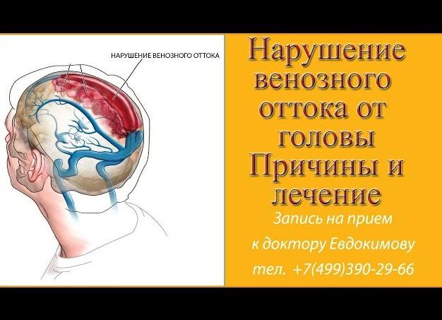 Нарушение венозного оттока головного мозга: в шаге от отека