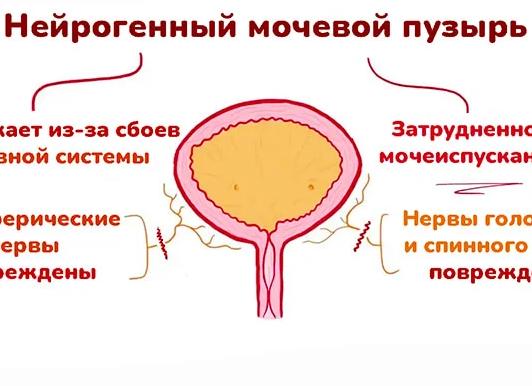 Нейрогенный мочевой пузырь у мужчин – симптомы нарушения